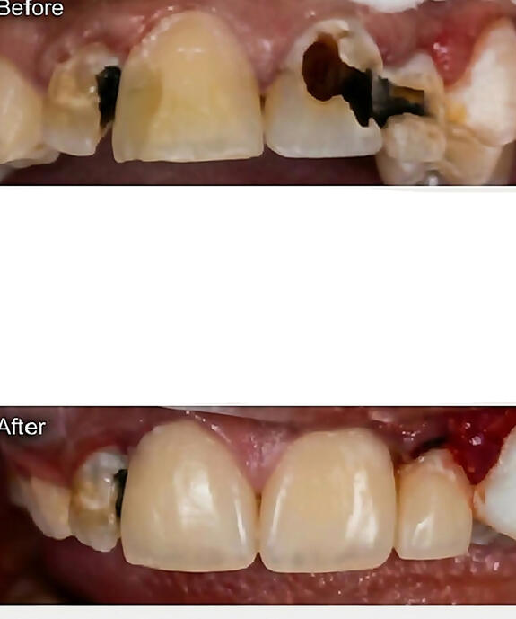ترميم الاسنان بالحشوات الضوئية التجميلية