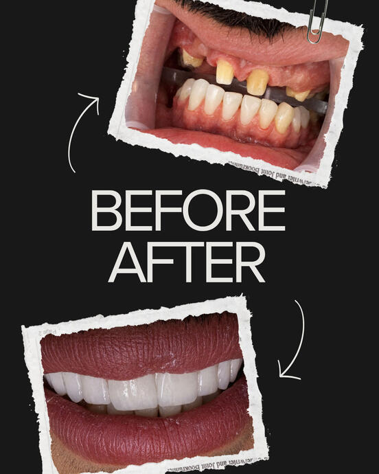 تركيبات زيركون للفك العلوي