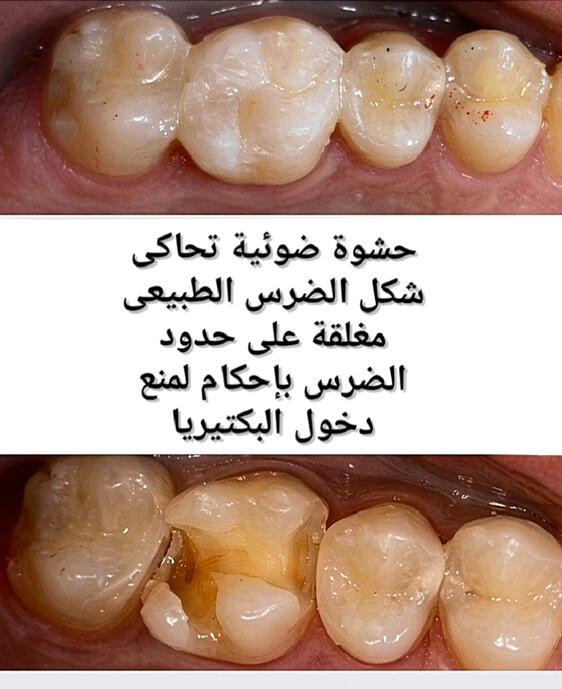 حشوة ضوئية للأسنان الخلفية